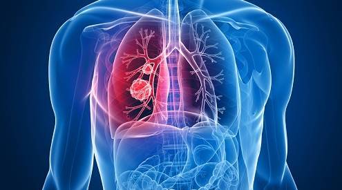 预防肺癌：生活习惯与定期体检的重要性